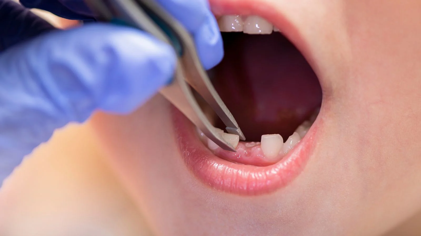 Rüyada Dişlerin Çekilmesi Düşmesi Görmek