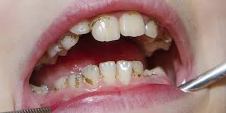 Rüyada Dişleri Temizlemek Görmek