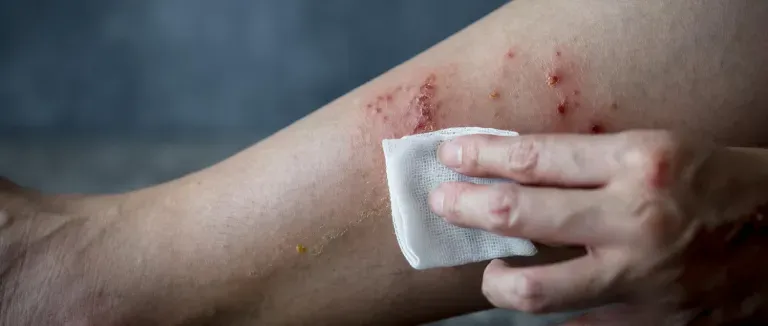 Rüyada Kaşıntı Görmek