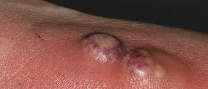 Rüyada İrin ve Kanlı İrin Görmek