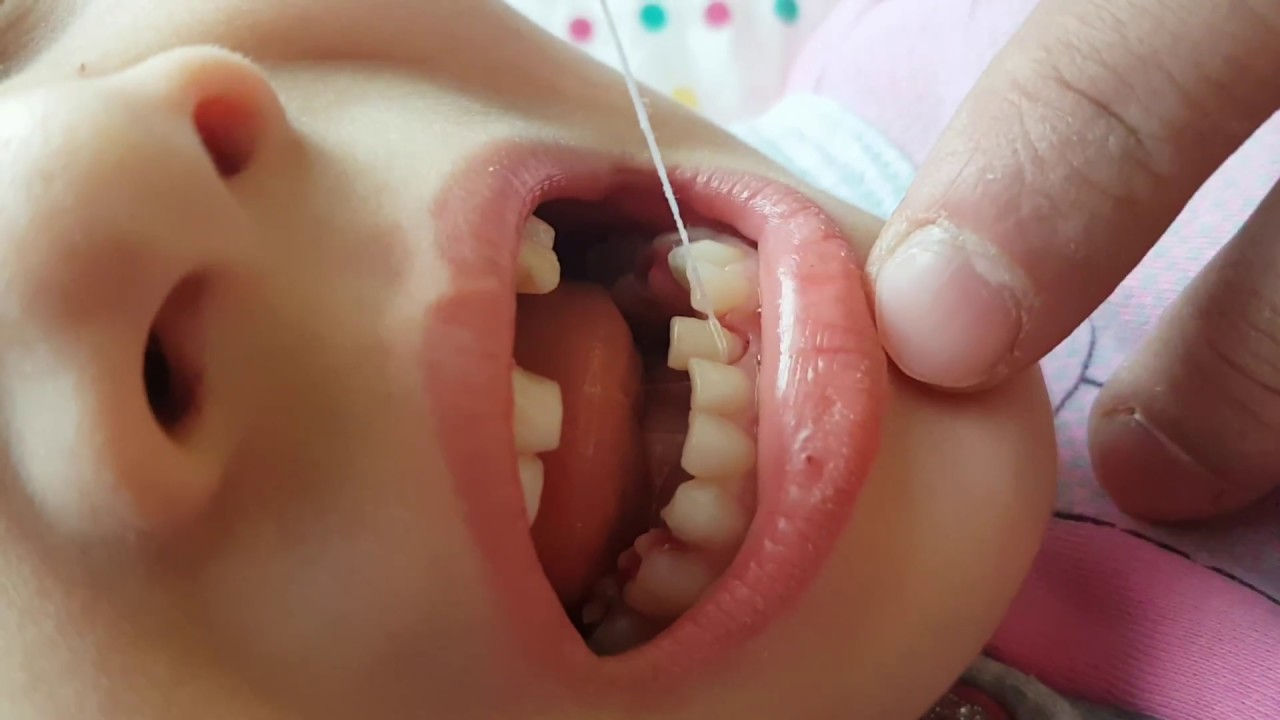 Rüyada Diş Çıkarmak Görmek