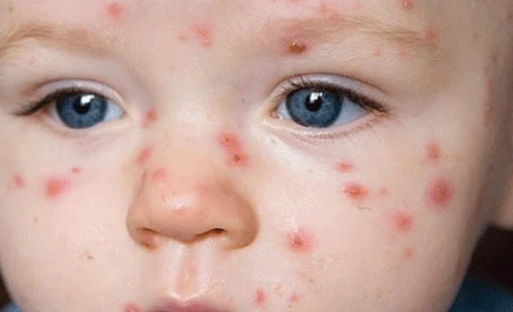 Rüyada Çiçek, Kızamık ve Egzama Görmek