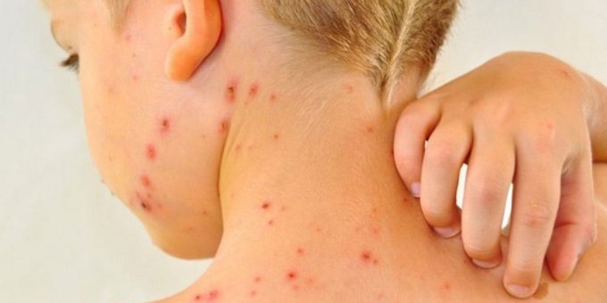 Rüyada Çiçek, Kızamık ve Egzama Görmek