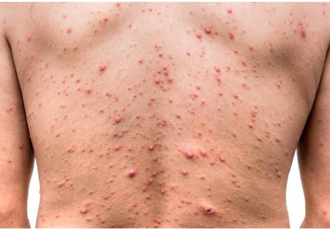 MAYMUN ÇİÇEĞİ NEDİR BELİRTİLERİ NEL...